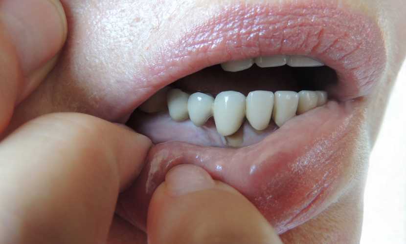 tratamiento de la enfermedad periodontal en el reino unido